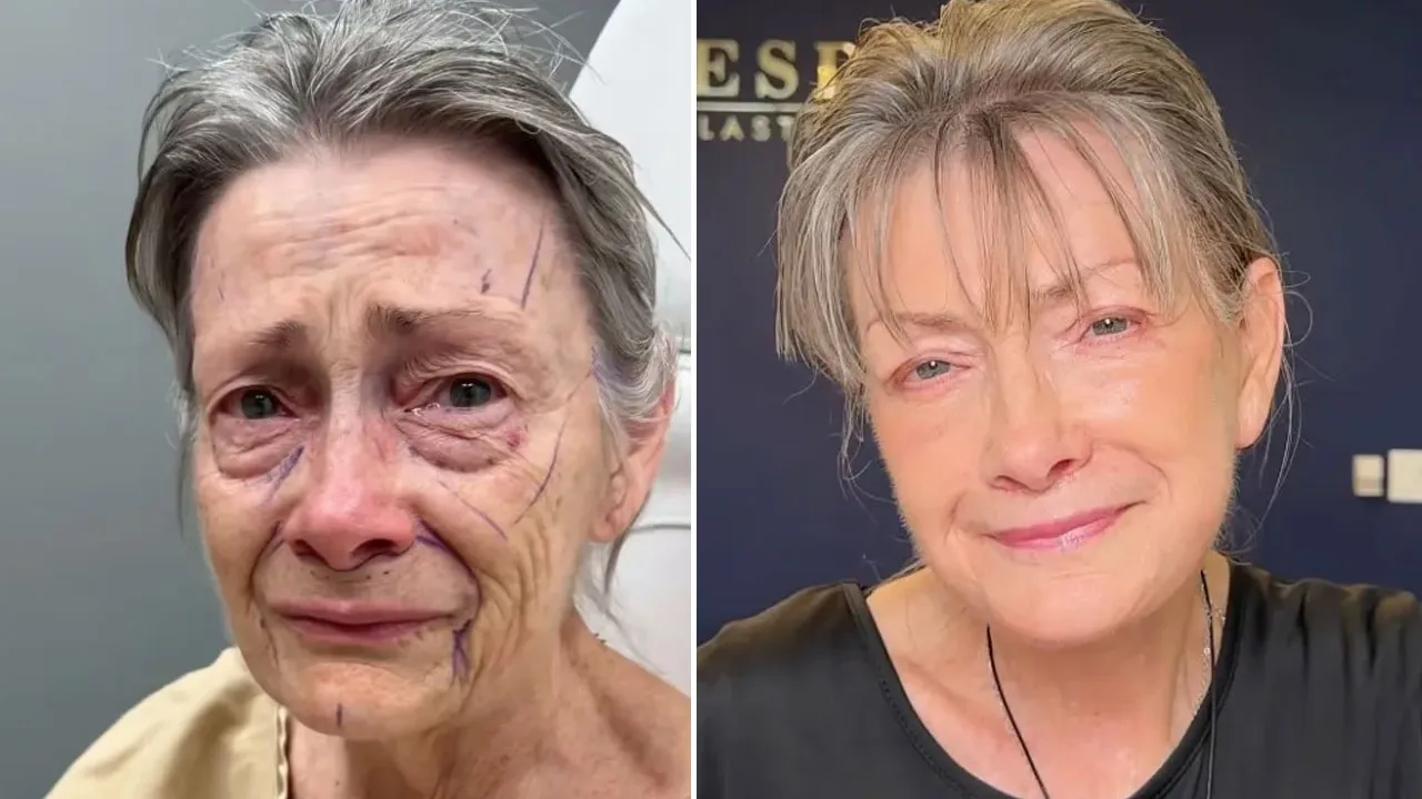 70 Yaşındaki Kadının Estetik Ameliyatla Dönüşümü Viral Oldu
