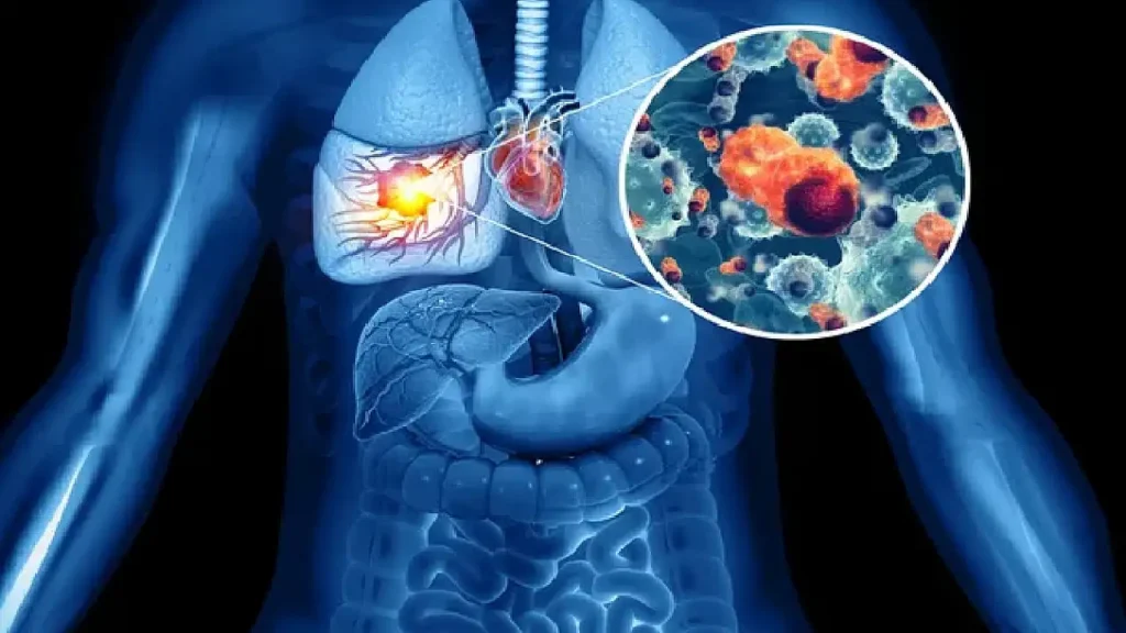 Akciğer Kanseri: Önlenebilir Riskler ve Erken Teşhis