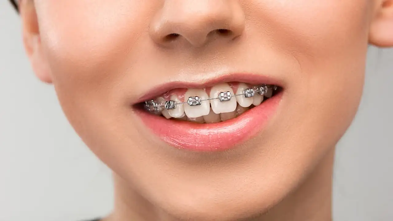 Diş Teli Tedavisi Her Yaşta Mümkün mü?