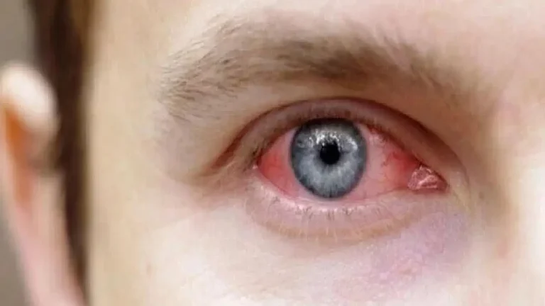 Gözdeki Masum Belirtiler Görme Kaybına Yol Açabilir