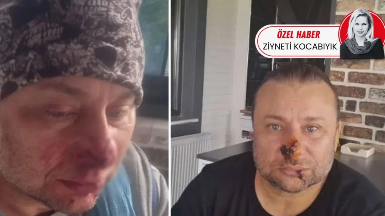 Pitbull Isırması ve Et Yiyen Bakteri Tehlikesi