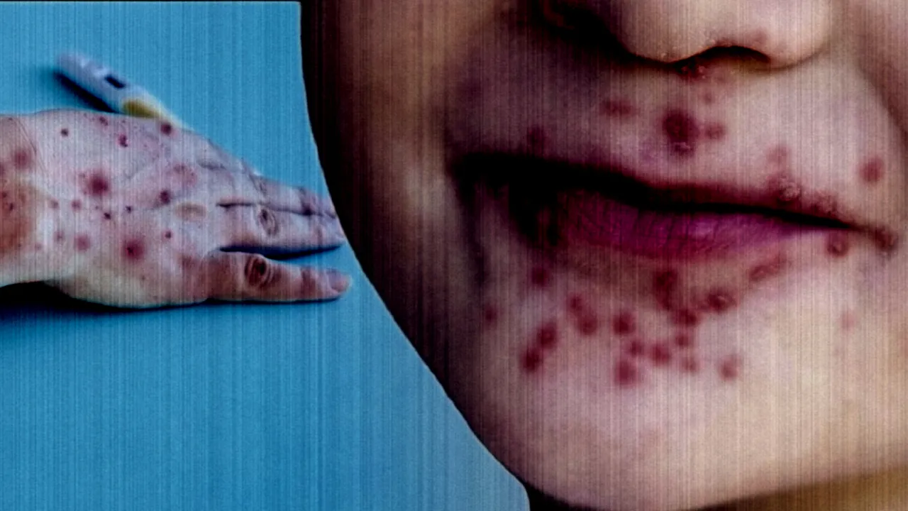 Çocuklarda el ve ağız hastalığı belirtileri ve önlemler